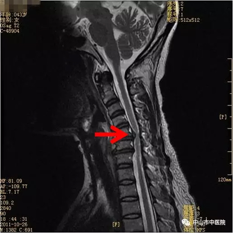 红色箭头处显示椎间盘向后突出,导致椎管狭窄,硬膜囊受压,颈椎5/6处颈
