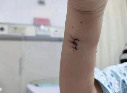 上周,中山市中医院显微创伤骨科收治了一名被竹签扎伤贯穿右手前臂