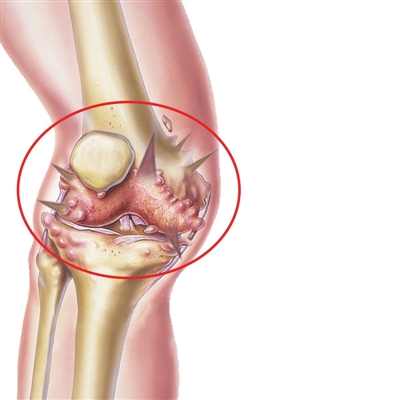 膝关节内清理出一碗骨头